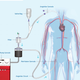 Illustration for article titled This Vampiric Vacuum Vants to Suck Your Blood (and Save Your Life)